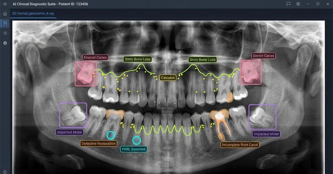 Panoramic X-ray with AI-detected findings